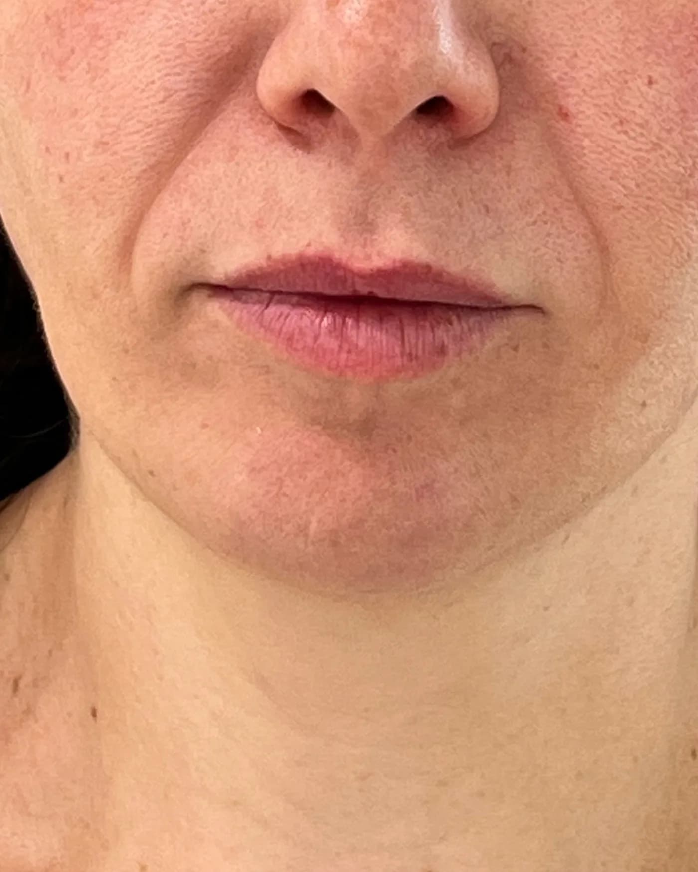 ANTES – Aumento de labios