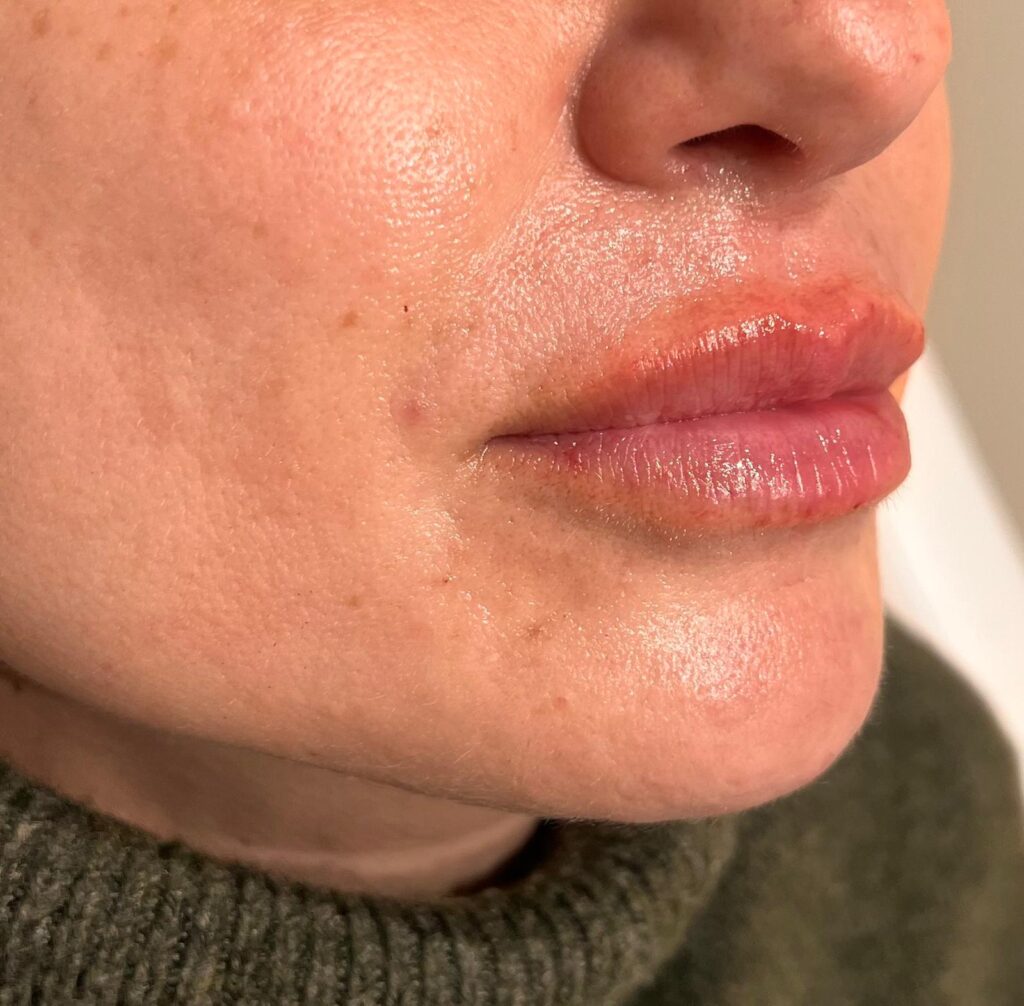 Después – Aumento de volumen de labios