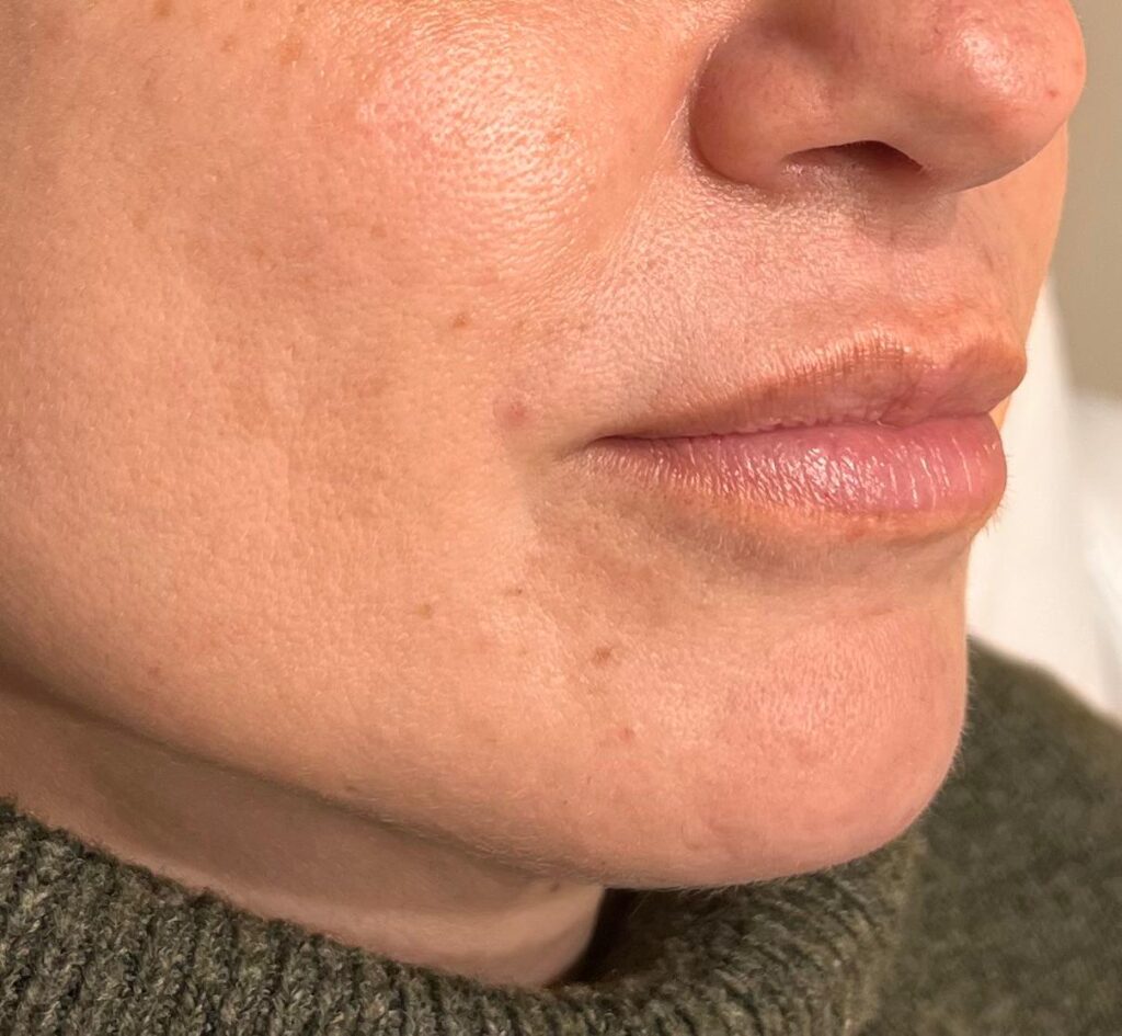 Antes – Aumento de volumen de labios