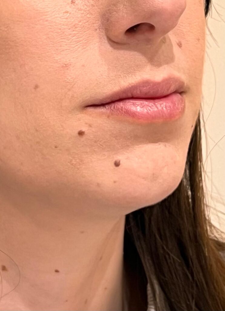 Antes – Hidratación de labios