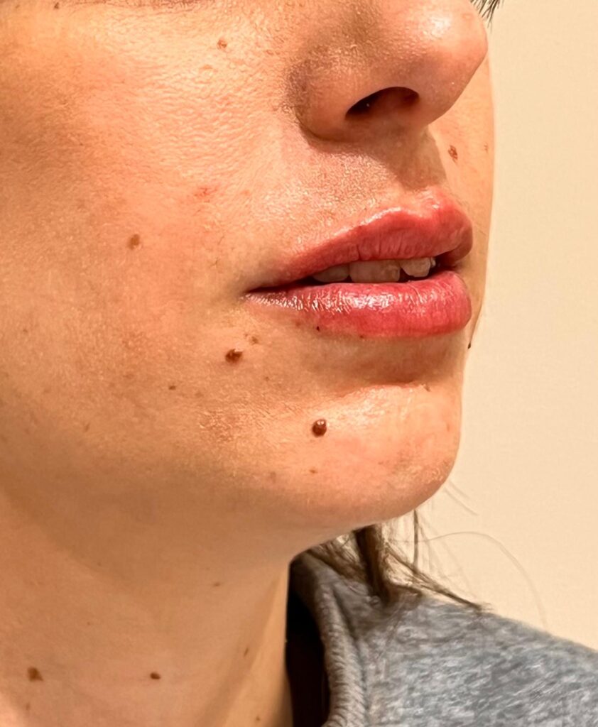 Después – Hidratación de labios